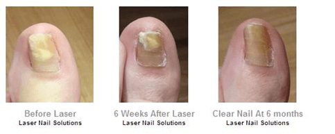 nail fungal laser