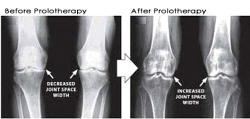 prolotherapy